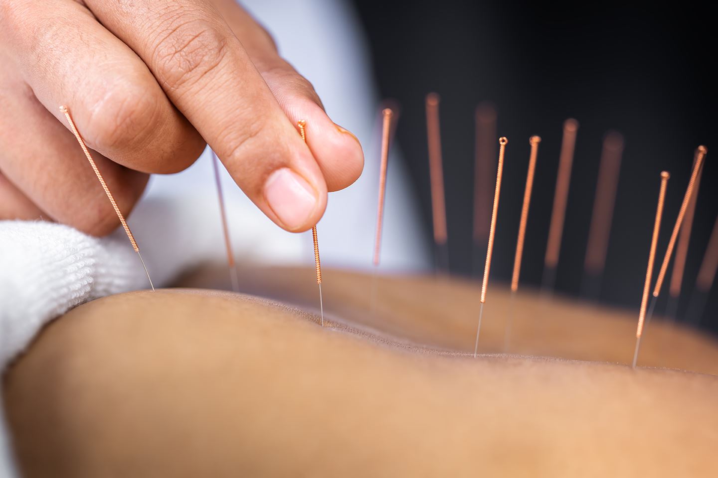 Akupunktur bei Kinderwunsch